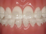 Ceramic Braces