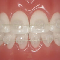 Ceramic Braces