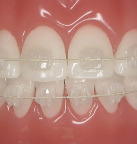 Ceramic Braces