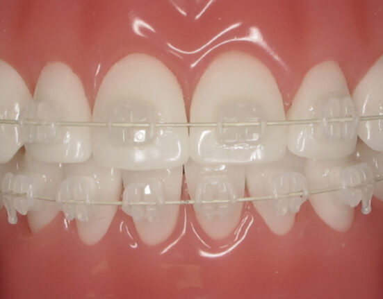 Ceramic Braces